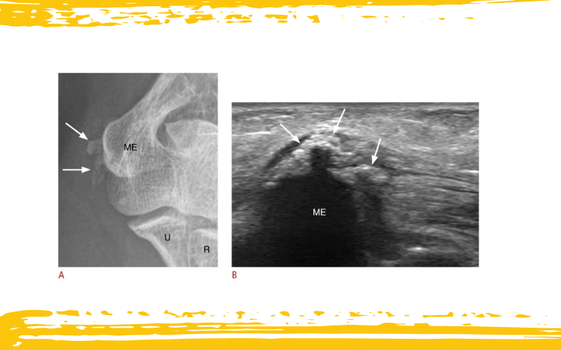 3. Diagnostico diferencial parte 1 ecografia tempo formacion.png